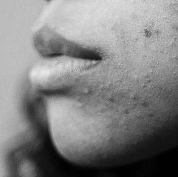 benzoyl peroxide washes benzoyl peroxide washes